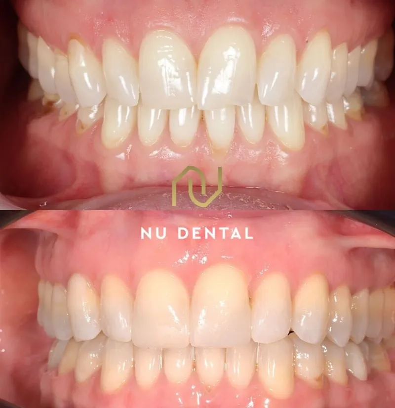 Before-and-after teeth-straightening case 03