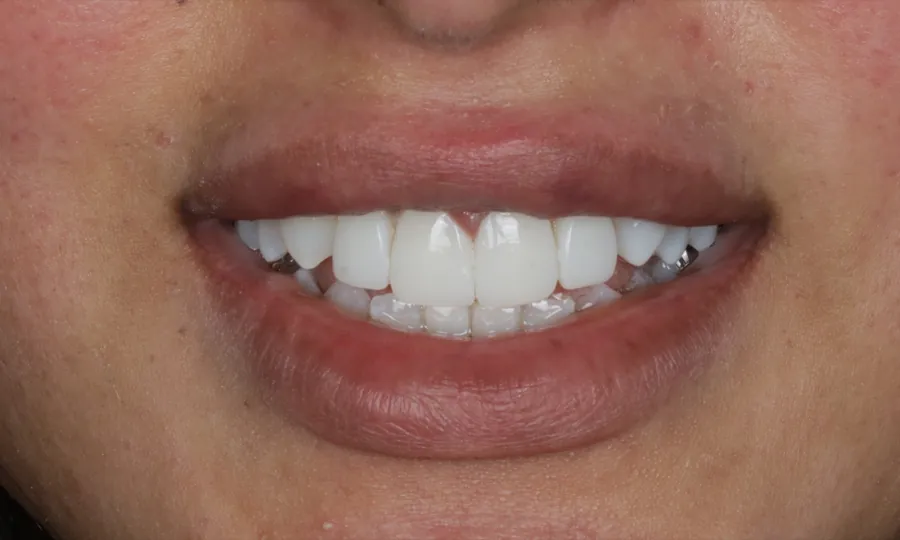 After clear aligner treatment, case 05